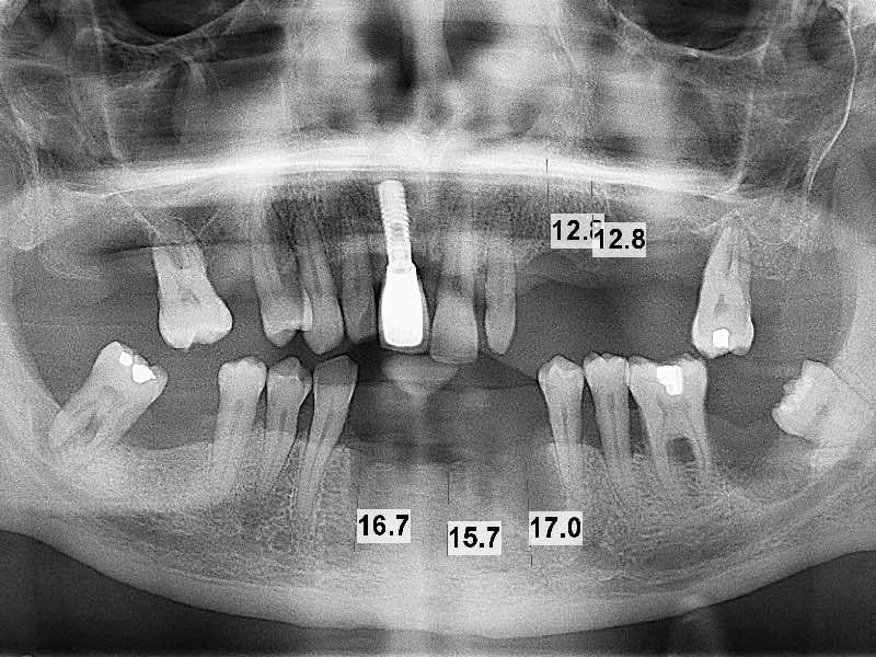 Zánět dásní - parodont