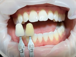 Výsledek kombinovaného bělení zubů