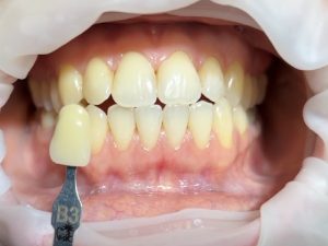 Původní stav před bělením zubů