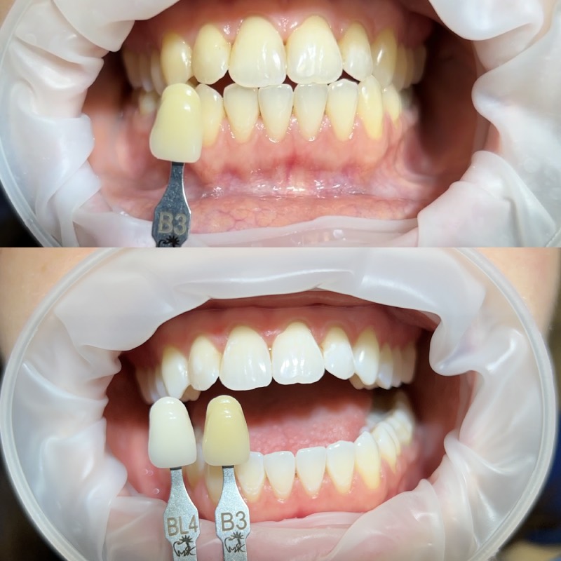 Image_kombinované bělení zubů